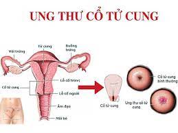 UNG THU SS